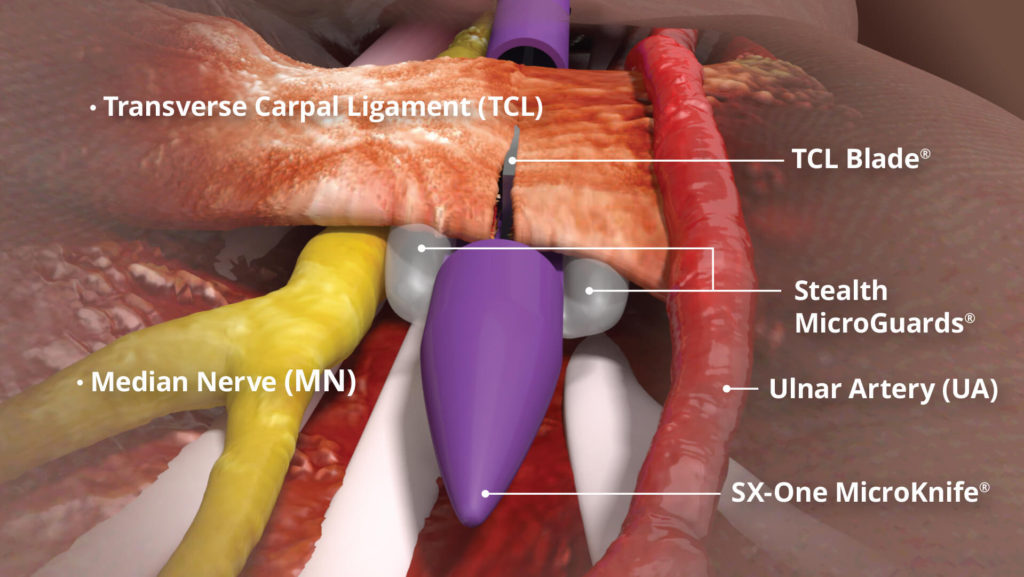 Carpal Tunnel Repair Near Me