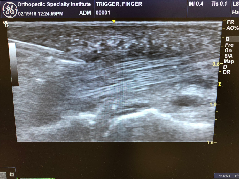 Trigger Finger Ultrasound